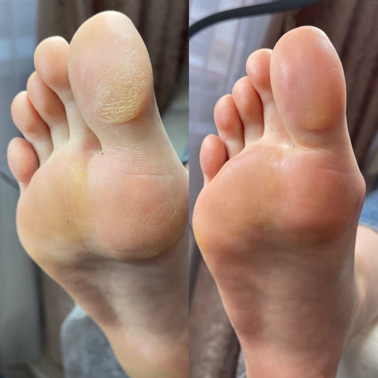 REMOVEDOR DE CALLOS DE 120ML